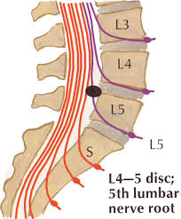 Când discul herniază, fibrele din componența inelului fibros se rup, și porțiunea interioară (nucleul pulpos) se scurge. Soc Pentru Chiriches Va Avea Dureri ToatÄ ViaÅ£a