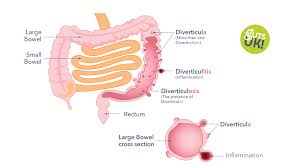 Image result for Diverticulitis