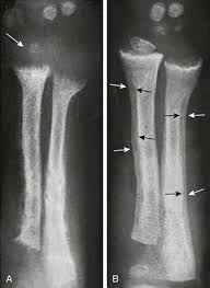 Metabolic Bone Disease Radiology Key