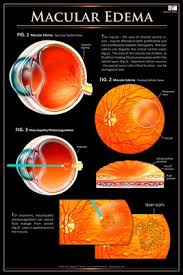 Eye Wall Charts Macular Edema Eye Wall Chart 517 Magcloud