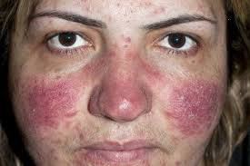 La peau a une coloration rougeâtre permanente, avec des crises de boutons qui peuvent générer du pus et qui durent plusieurs jours. Rougeur Diffuse Du Visage Ou Erythose Et La Rosacee Club Des Estheticiennes