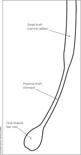 A noticeable length increase in hair follicle length was observed in 50% of the hc007 1.5% samples. Hair Loss Common Causes And Treatment American Family Physician