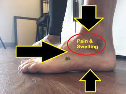 Pin On Sinus Tarsi