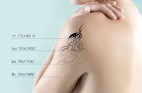 The experience was not very painful and martin was a great laser specialist. Tattoo Removal Amerejuve Medspa