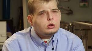 Burned firefighter receives man's face in transplant