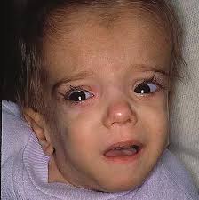 Comparison Chart of Systemic Autoinflammatory Diseases (SAID) Involving  Periodic Fevers