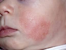 Fortunately, there are ways to reduce the risk of eczema triggers in babies, like switching to a symptoms include dry, red patches of skin on the face or body, in particular on the face and scalp, or behind the ears, and inside the elbows, knees. Baby Eczema Causes Symptoms Treatments And Creams Babycentre Uk