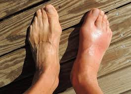 Wordpress Com Essential Oils For Gout Gout Remedies Gout
