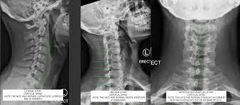 It's commonly done after someone has been in an automobile or other accident. Normal Cervical Spine X Ray C N S Neurosurgery