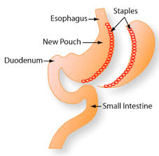 Your local bariatric specialist's office staff can also check to see if you have coverage. Gastric Sleeve Costs And Insurance Guide Bariatric Journal