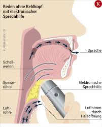 Wie Man Ohne Kehlkopf Sprechen Kann