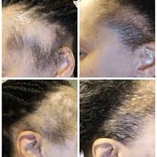 Extra Strength Formula D Hair Growth Oil With Amla Coconut Oil Jbco For Receding Hairline Dht Blocker Men Or Women Alopecia In 2020 Alopecia Hair Growth Alopecia Hairstyles Hair Growth Oil