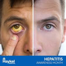 Hepatitis B is a disease of the liver caused by an infection with the  hepatitis B virus (HBV). Some people who become infected can go