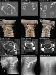 Surgical Treatment Of Adult And Pediatric C1 C2 Subluxation With Intraoperative Computed Tomography Guidance Scienceopen