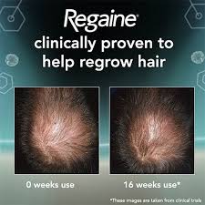 This hair loss treatment is available over the counter. Regaine For Men Hair Loss Treatment Regaine Uk