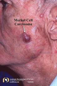 Image result for Merkel Cell Carcinoma