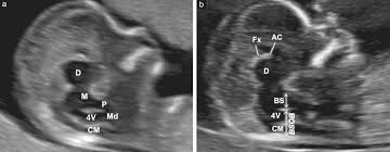 Image result for First Trimester Ultrasound