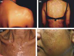 Image result for Postinflammatory Hypopigmentation