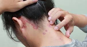 ماذا تسبب بكتيريا و فطريات فروة الرأس ويب طب