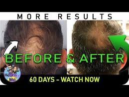 Its high content of sulfur, flavonoids, and antioxidants has been clinically suggested to work for the reversal of hair loss. Onion Juice Hair Regrowth New Pics 60 Days Before After Results Youtube Onion For Hair Hair Loss Remedies Hair Loss