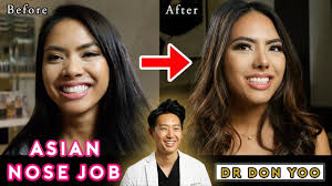 Kathryn Undergoes Asian Rhinoplasty With Rib Cartilage And Diced Cartilage Fascia Dcf To Create Greater Refinement Nose Job Rhinoplasty Nose Jobs Rhinoplasty