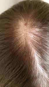 It is a very common cause. I Just Want To Know What Is Causing The Hair Loss And If The Brown Marks Are Something Concerning Photo