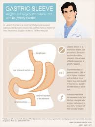 Excellent Infographic On Bariatri Surgery Gastric Sleeve Procedure From Specialized Bariatric Surgeon Dr Gastric Sleeve Surgery Sleeve Surgery Gastric Sleeve