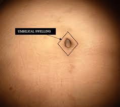 Image result for Umbilicus