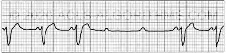 Este un bloc de conducție între atrii și ventriculi. Second Degree Av Block Type 2 Acls Algorithms Com