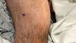 Image result for Septic Joint