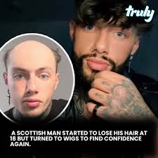 At just 18, Nick began experiencing hair loss, a struggle that quickly took  a toll