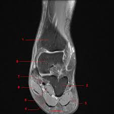 Start studying mri procedures foot/ankle review. Mri Of The Ankle Detailed Anatomy W Radiology