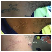 Most patients get a strong topical unaesthetic cream or injection to suppress the pain. Empower Evolve Enlighten Picosecond Tattoo Removal And A High Volume Practice Cutera