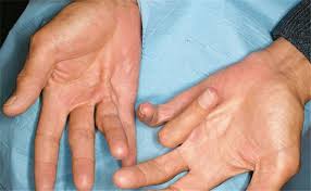 Learn more about vte causes, risk factors, vte prevention, vte symptoms, vte complications and treatments, and clinical trials for vte. Strahlen Gegen Streckhemmung Der Finger