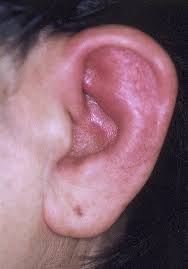 Image result for Relapsing Polychondritis