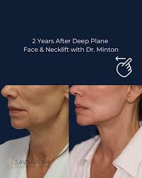 Tim Minton, MD, FACS