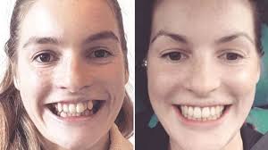 Visit www.badbacks.com.au for our full product catalogue or visit a store near you in melbourne, sydney and perth. Adult Braces Why Are More Grown Ups Getting Their Teeth Straightened Bbc News