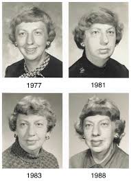 Image result for Acromegaly