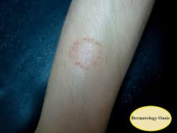 Maybe you would like to learn more about one of these? Nummular Eczema Dermatology Oasis