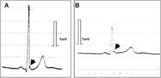 Image result for Early Repolarization