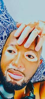 Share your Story » Global Autoimmune Institute