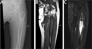 Image result for Chondrosarcoma