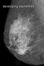 What does breast cancer look like on a mammogram? Breast Mammogram Shows Mass What To Do Next