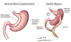 gastric byp versus gastric sleeve