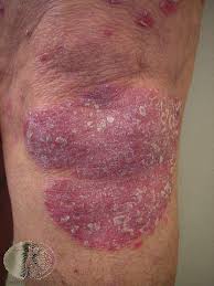 Image result for Psoriasis