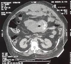 We did not find results for: Benign Cystic Mesothelioma Of The Peritoneum A Case Report And Literature Review World Journal Of Emergency Surgery Full Text