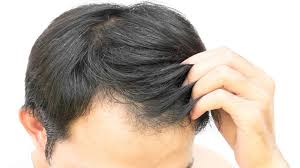 Both men and women develop this type of hair loss, which is the most common cause of hair loss worldwide. Reason Of Hair Fall In Young Men Due To Various Diseases My Poll Ux Internet Of Things