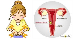 Treatments include surgery, chemotherapy, and radiation therapy. Most Women Miss These 3 Early Signs Of Cervical Cancer David Avocado Wolfe