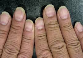 Know the causes, symptoms, treatment and home one of the symptoms of beau's line or horizontal ridges may be the growth of multiple nails from a single finger root. Muehrcke Lines Litfl Medical Eponym Library