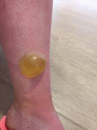 Pregnant Mum S Sunscreen Warning After Severe Sunburn Left Her With A Huge Pus Filled Blister Caters News Agency